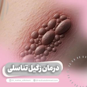 درمان زگیل تناسلی